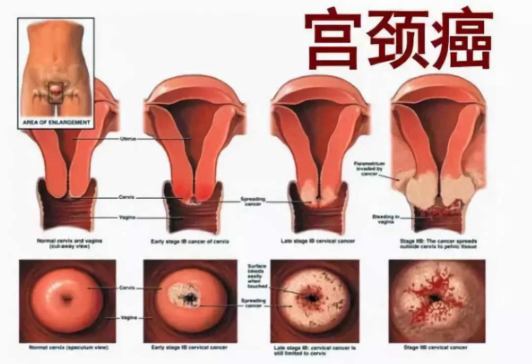 贝伐珠单抗说明书_贝伐珠单抗宫颈癌骨转移_贝伐珠单抗注射液