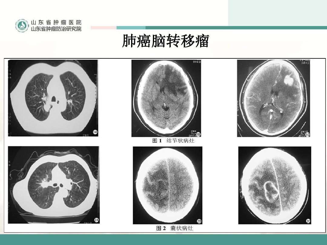 dnf韩服大转移骨戒_dnf大转移骨戒_吉非替尼对骨转移有效果吗