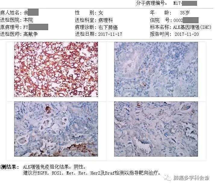 中国晚期非小细胞肺癌患者一线治疗的新型联合治疗方法