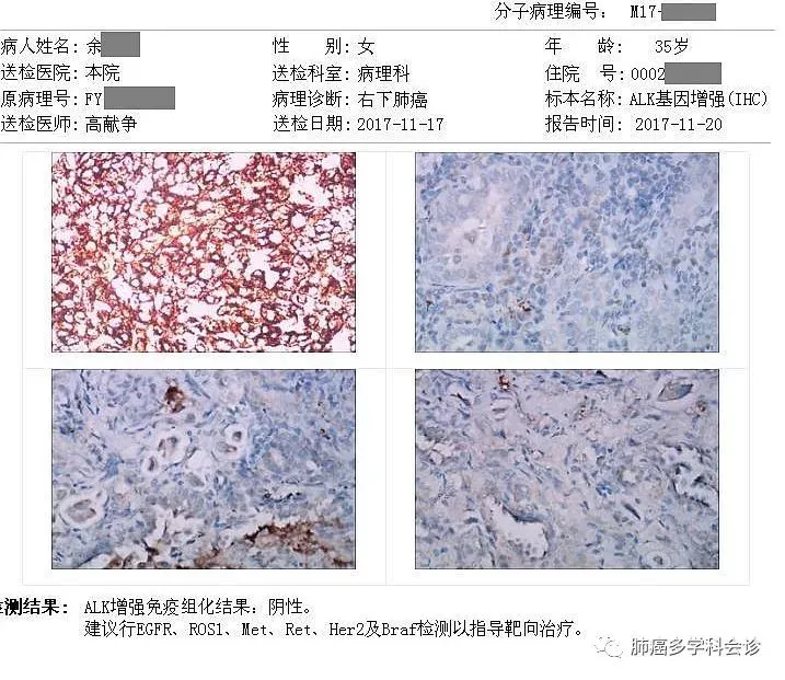 贝伐珠单抗4个月后赠药_贝伐珠单抗对肺癌晚期脑转移_贝伐单抗对肺癌有用吗