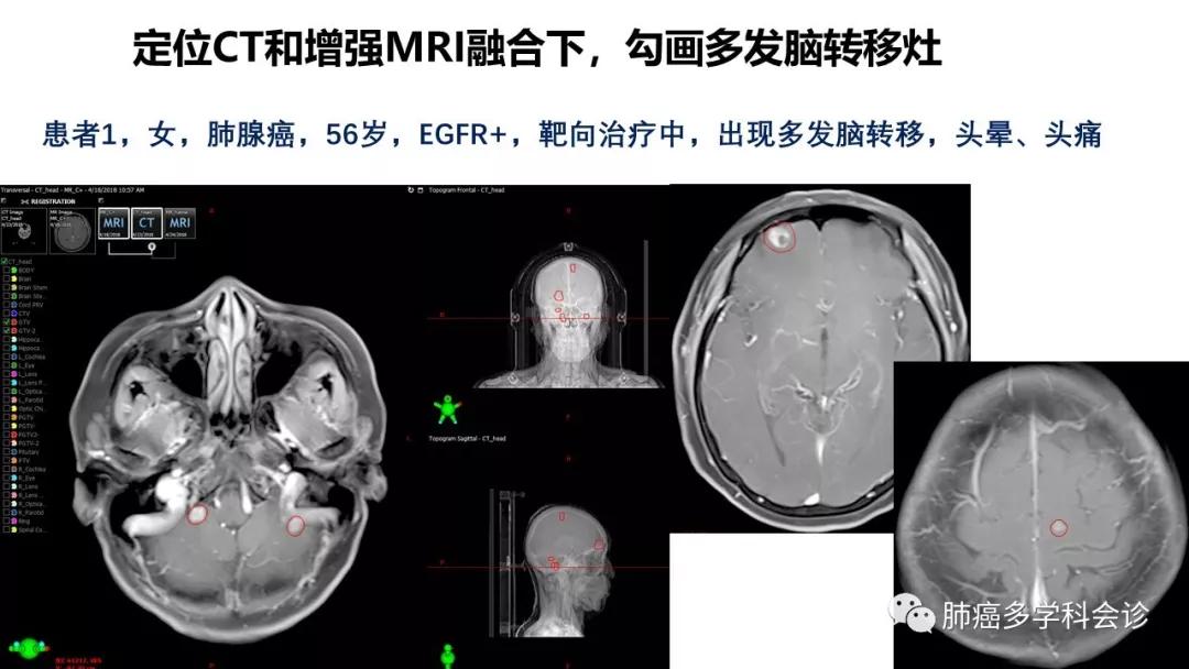 肺癌脑转移的症状有哪些？如何处理？更多功能？