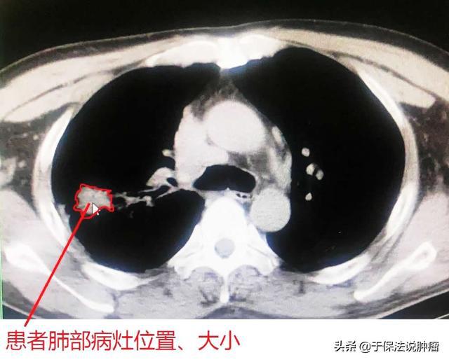 肺癌脑转移吃奥希替尼最长耐药