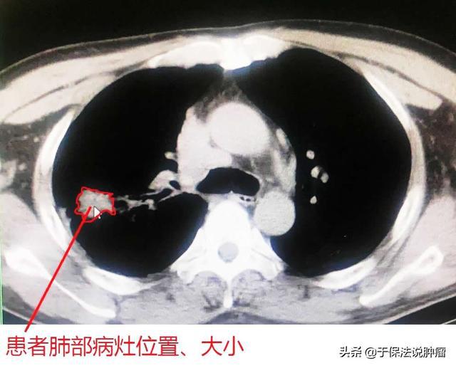 肺部肿瘤中医治疗_肺部肿瘤能治疗好吗_肿瘤转移至肺部能用吉非替尼吗