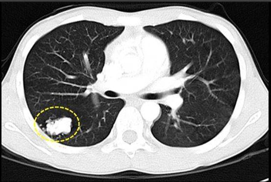 子宫内膜腺癌治疗_吉非替尼治疗腺癌吗_肺部原位腺癌手术后需要怎样治疗