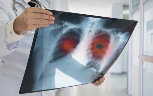 
肺癌的治疗方法有外科治疗、放射治疗、化学疗法和免疫疗法