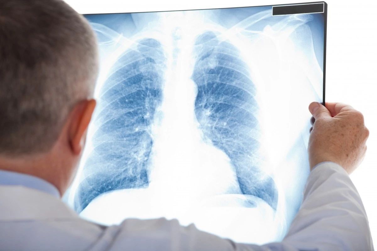 
肺癌的发病率及死亡率分别占全部恶性肿瘤的分别居所有癌症首位