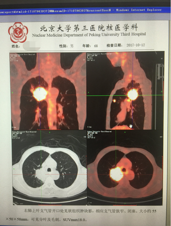 特罗凯+贝伐珠单抗联合治疗肺癌，疗效比单独用