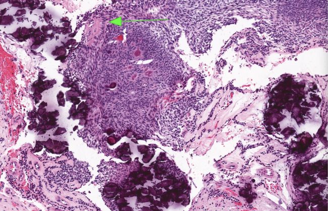 
信达生物用于治疗成人复发性胶质母细胞瘤（GBM）