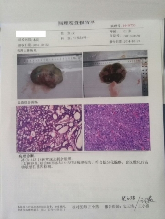 贝伐单抗对脑转移癌有效_贝伐单抗卵巢癌剂量_贝伐珠单抗是化疗药吗