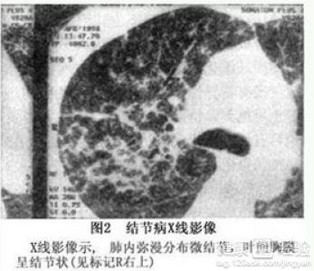 吉非替尼治哪一种肺癌_克唑替尼治愈肺癌案例_12种肺癌肿瘤标志物
