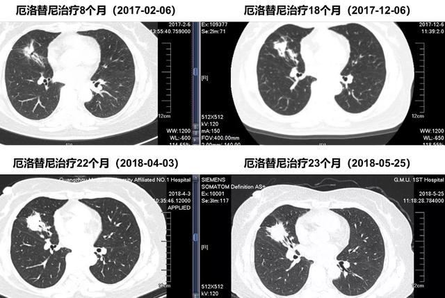 12种肺癌肿瘤标志物_克唑替尼治愈肺癌案例_吉非替尼治哪一种肺癌