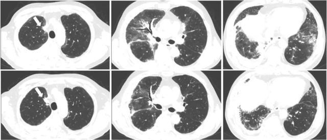 左肺IV期19突变，肺癌患者的一丝精准化治疗

