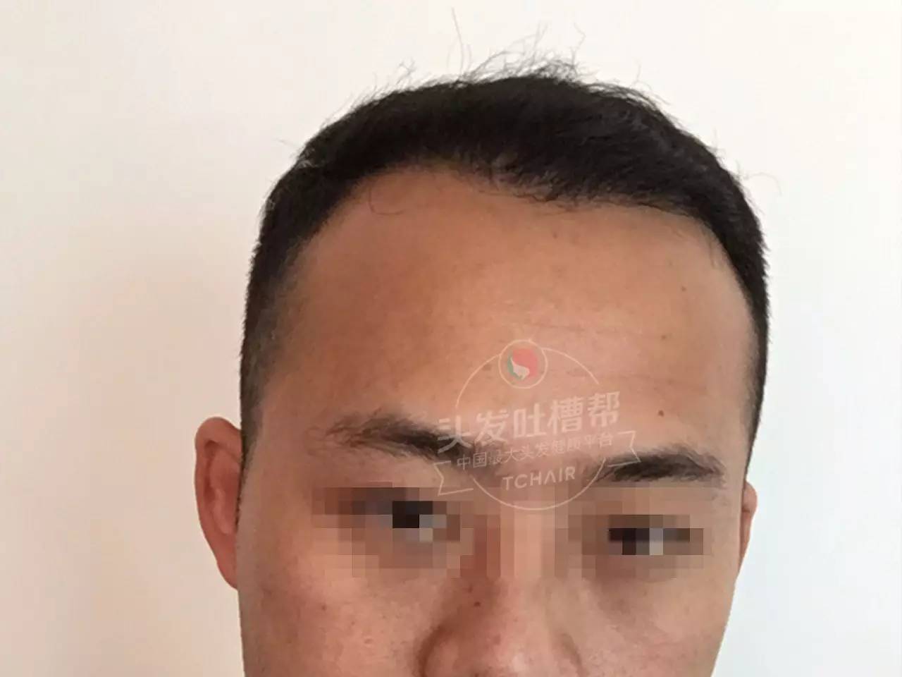 吉非替尼对肺癌晚期有啥作中_肺癌晚期脑转移骨转移 服务埃克替尼 能活多久_肺癌有空洞了是晚期吗