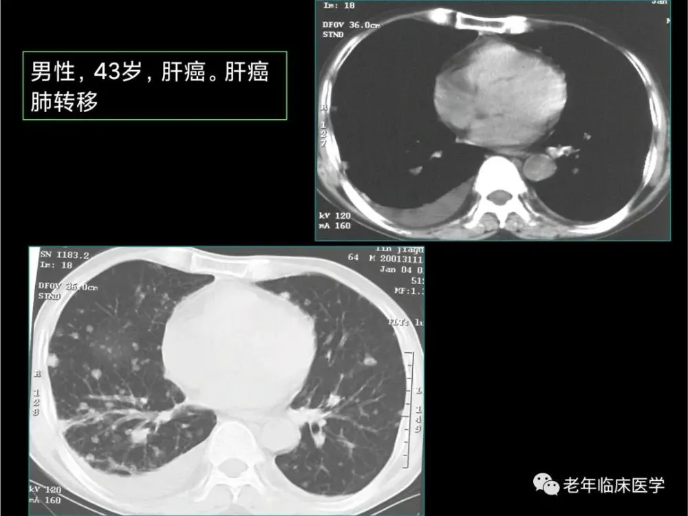 肺癌已成为人类因癌症死亡主要原因，死亡人数约占所有癌症人数的三分之一