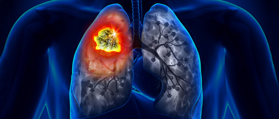 肺癌已经跃升为人类的第一大杀手，吉非替尼
