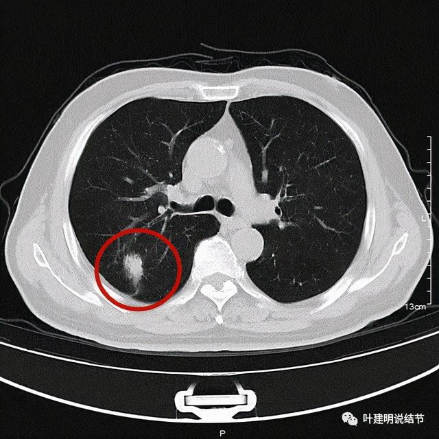 吉非替尼耐药后基因无突变_索拉非尼耐药后换索坦_肺癌寡转移,基因无突变