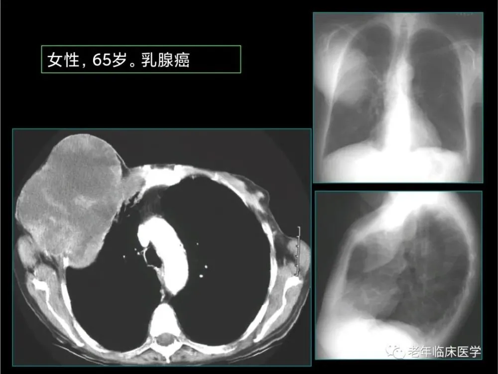 奥希替尼9291_吃奥希替尼鼻子肿_进口奥希替尼
