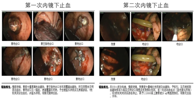 贝伐单抗血栓预防_贝伐珠单抗靶向是啥_贝伐珠单抗价格