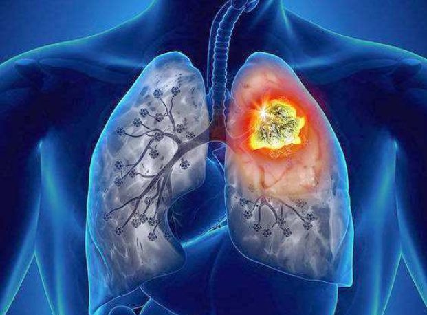 非小细胞肺癌患者确诊时已属晚期失去手术和放射治疗机会