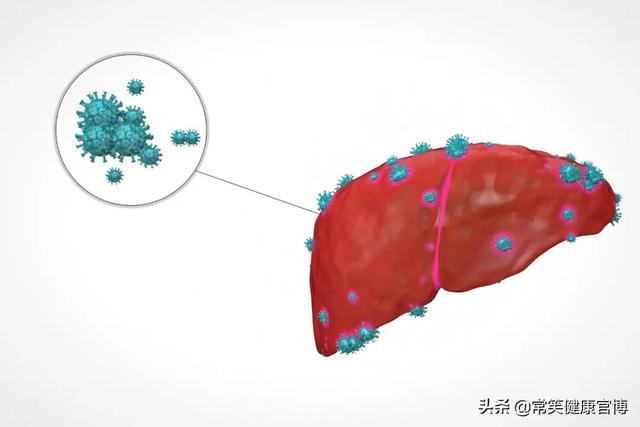 12年来肝细胞癌一线疗法成功打破多吉美(组图)