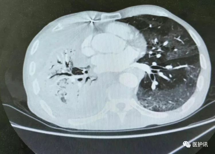 
吉非替尼片常见不良反应为腹泻、皮疹、瘙痒、皮肤干燥和痤疮