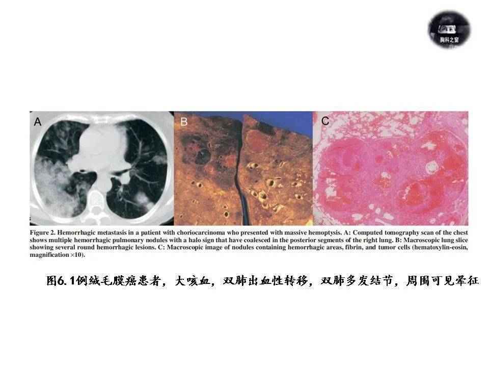 佛手片感冒后咳嗽可以炖水饮吗_咳嗽吃咳啖净片可以吗_吉非替尼片吃用后咳嗽