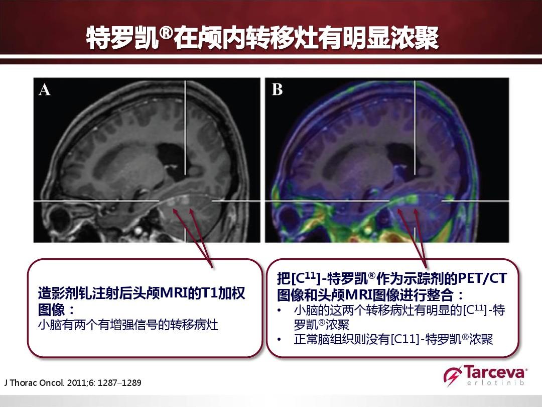 EGFR突变患者容易出现脑转移，该如何治疗呢？