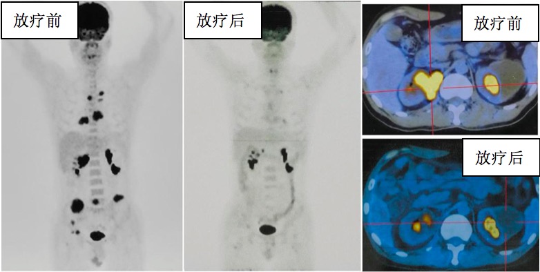 蔡林波专家教授脑膜迁移蔓延癌的原因是什么？