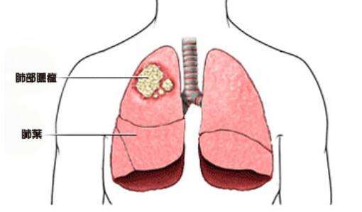 易瑞沙吉非和吸烟对肺癌发病有相互促进的疗效要比腺癌和肺泡癌低