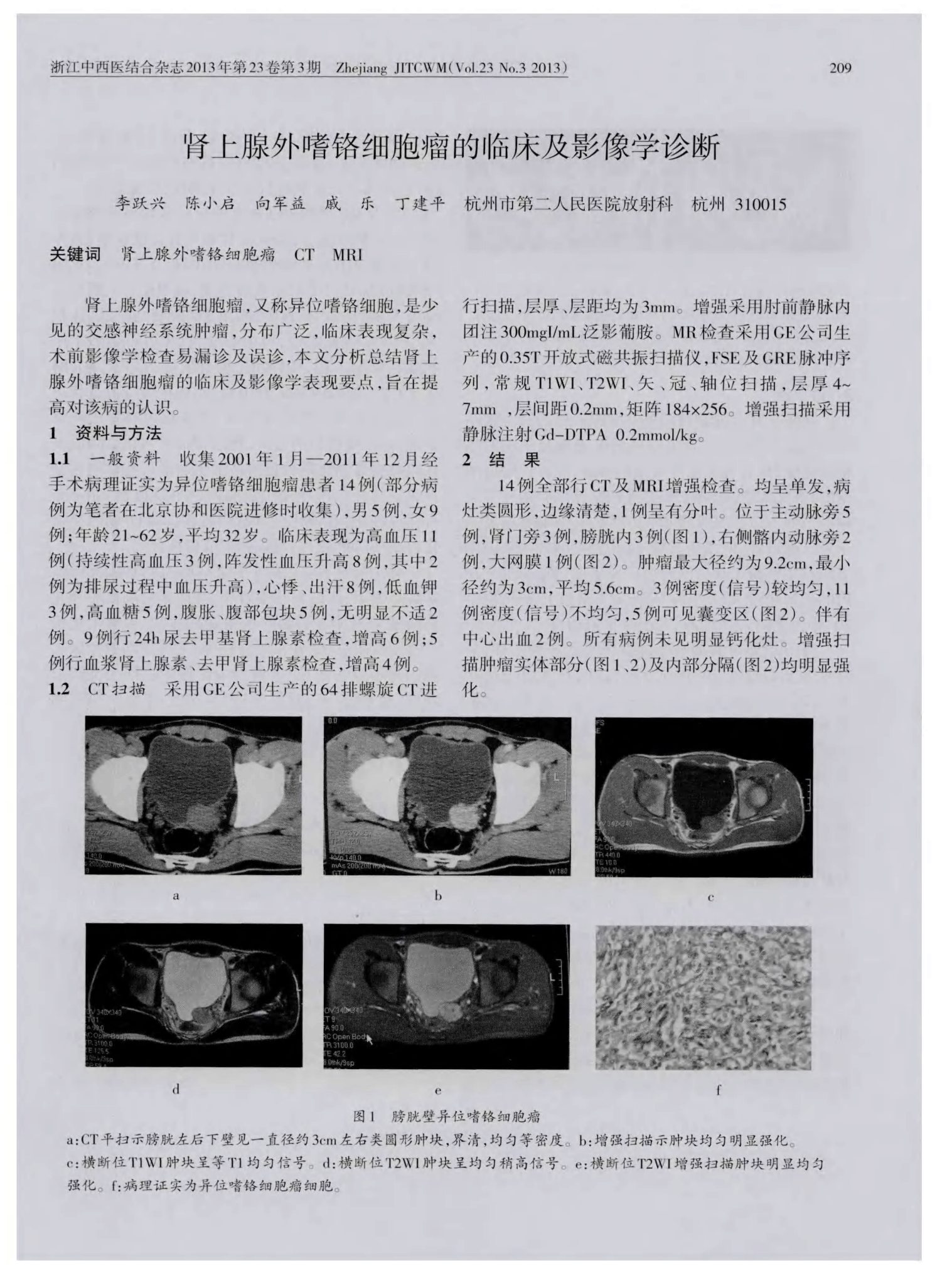 贝伐珠单抗靶向是啥_贝伐珠单抗治疗后乏力_贝伐珠单抗多少钱一支