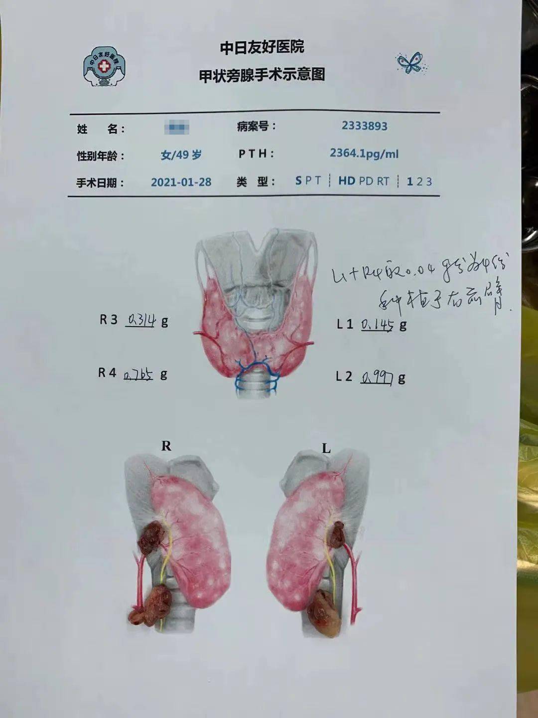 贝伐珠单抗可以报销吗_贝伐珠单抗用于krsa_结肠癌晚期 贝伐珠单抗