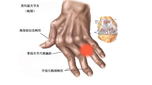 吃奥希替尼10天病情恶化了_奥希替尼9291_奥希替尼印度版多少钱