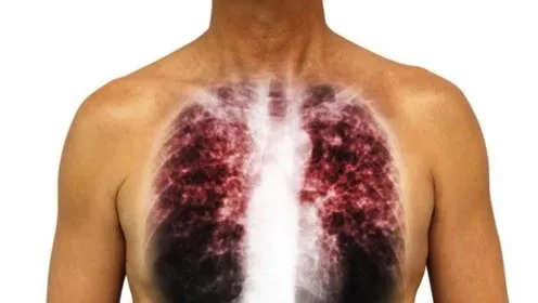 奥希替尼的尼一线治疗肺癌患者的效果二三线治疗