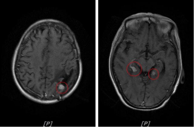 EGFR-TKI突变阳性晚期，脑转移发生率超过45%