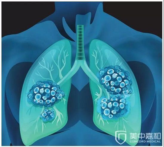 阿帕替尼多长时间耐药_吉非替尼耐药骨转移吃_克唑替尼耐药什么表现?