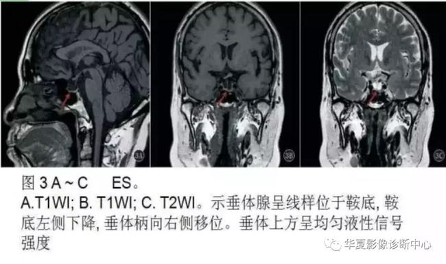 贝伐单抗是靶向药吗_贝伐单抗-阿瓦斯汀大陆卖多少钱?_贝伐单抗对恶性脑水肿
