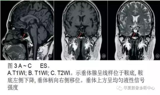 鞍旁脑膜瘤立体定向放疗被推荐为一线治疗提供参考