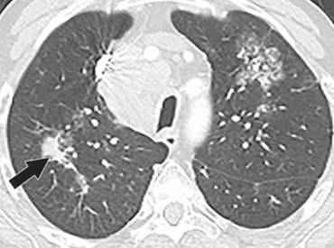 右中肺低分化腺癌伴双肺多发结节活检术的临床症状