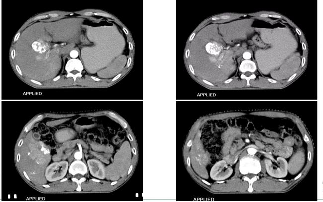
晚期肝癌患者中，靶向治疗等手段也进入大众视野
