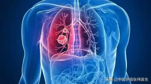 贝伐单抗对肺癌有用吗_肺癌新药贝伐单抗_贝伐珠单抗肺癌临床研究
