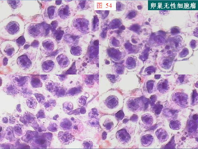 贝伐珠单抗说明书_贝伐珠单抗多少钱一支_贝伐珠单抗是药吗