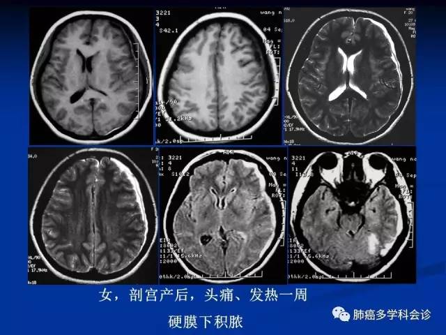 阿斯利康 奥希替尼_奥希替尼容易脑膜转_香港买奥希替尼多少钱