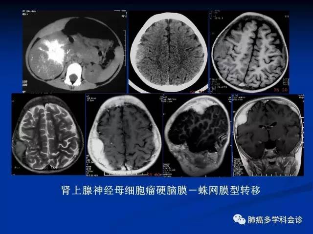 奥希替尼容易脑膜转_香港买奥希替尼多少钱_阿斯利康 奥希替尼