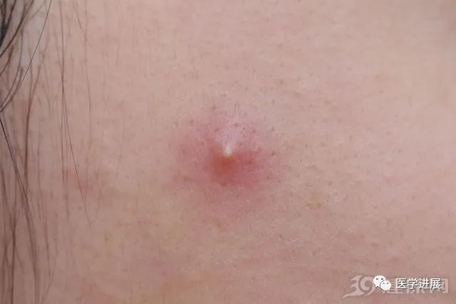 贝伐珠单抗护士配置注意事项_贝伐珠单抗_贝伐珠单抗多少钱一支