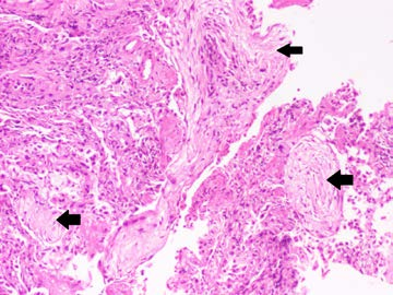 【医学微视】胸部CT血管造影发现双侧亚厘米肺结节