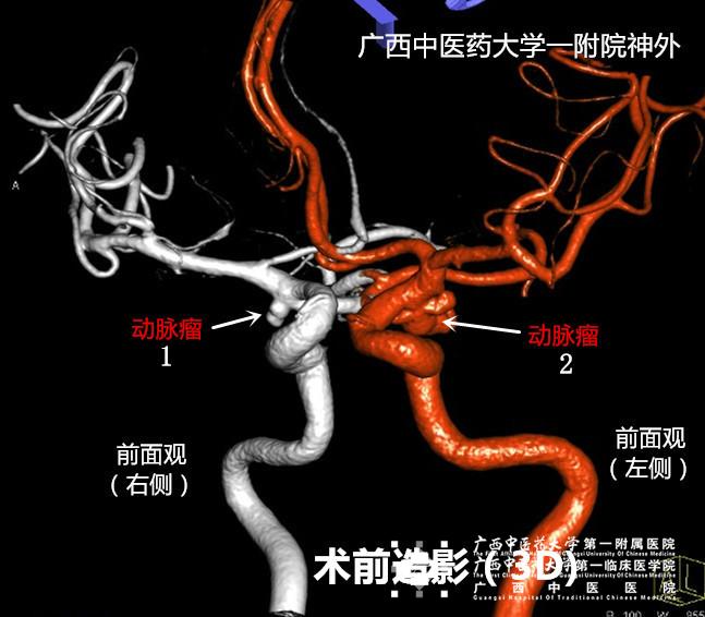 贝伐珠单抗多久用一次_脑干胶质瘤用贝伐单抗_贝伐珠单抗不良反应