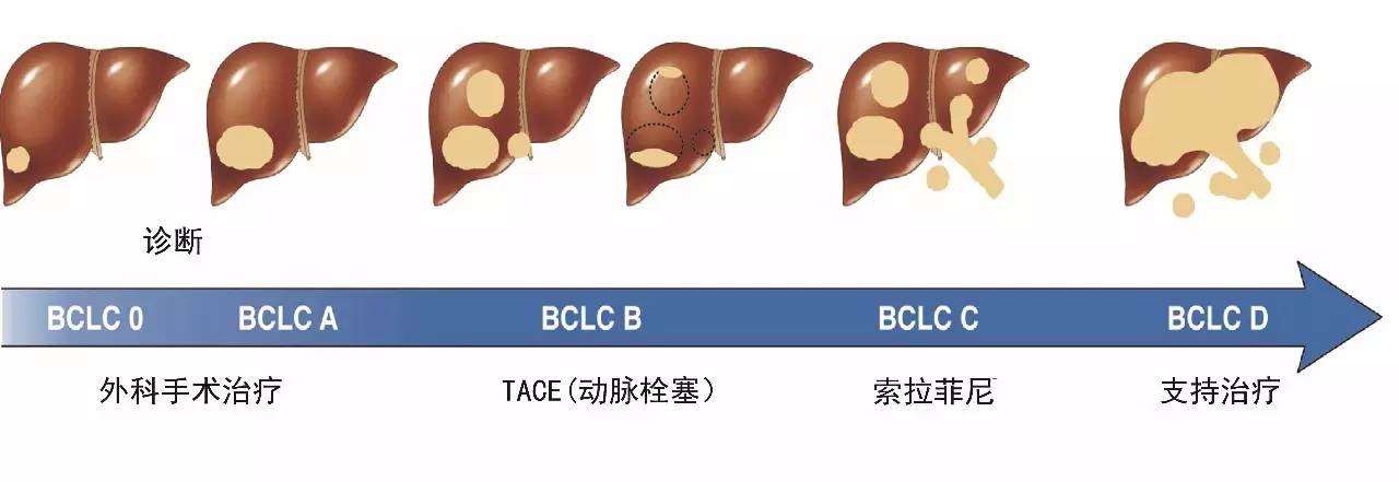 索拉非尼尼靶向治疗为中晚期肝癌患者的生存带来了希望
