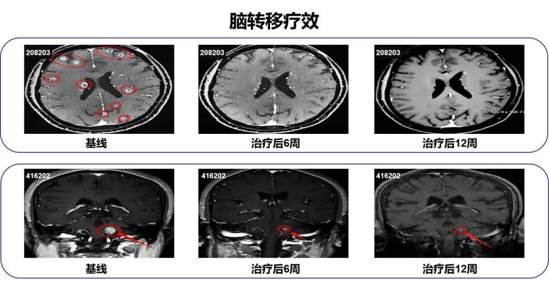 用黄体酮缓释凝胶后出现炎症_用吉非替尼后出现脑转移怎么办_用分区助手ssd转移后