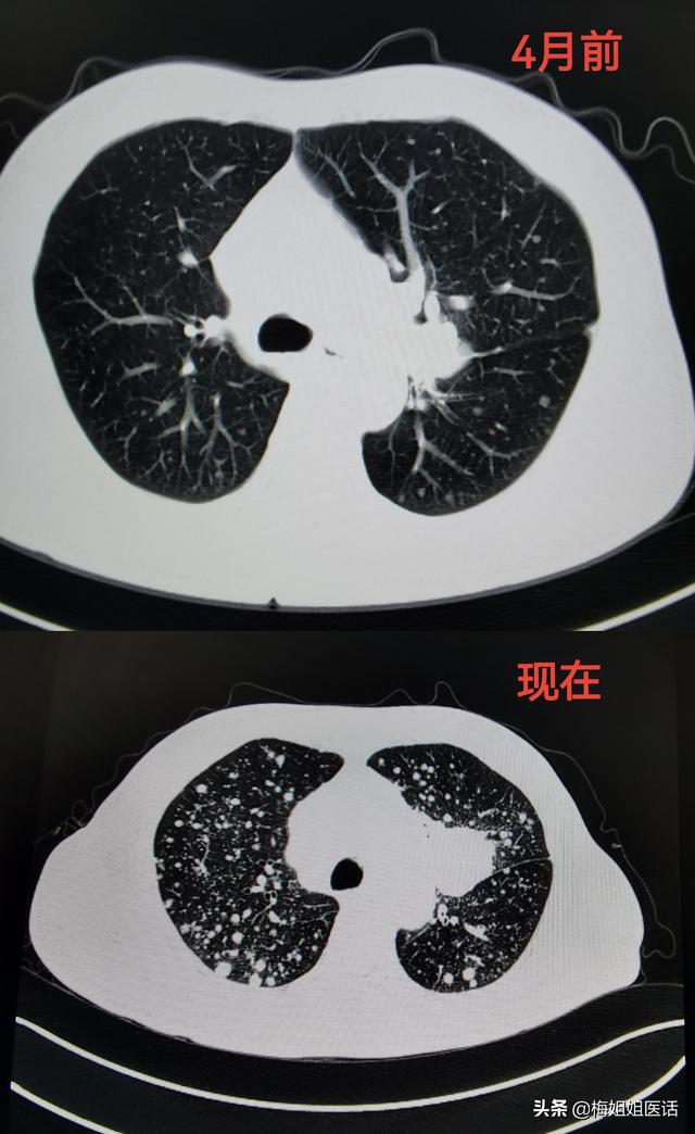 吉非替尼间质性肺炎_间充质干细胞疗法_间充质干细胞培养基