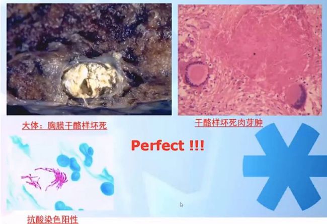 胸腔积液贝伐珠单抗_贝伐珠单抗注射液_贝伐珠单抗